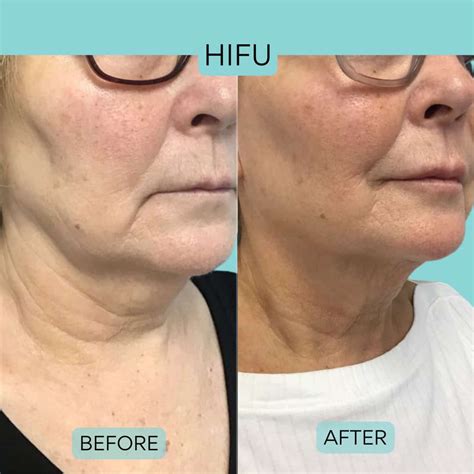 HIFU Before & After | Results | Vie Aesthetics