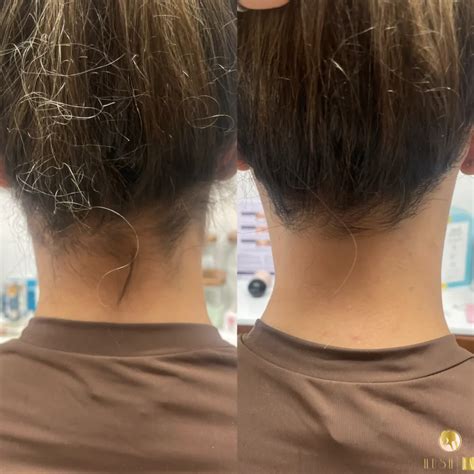 What’s the best solution for unwanted hair? - Hush LA Medspa