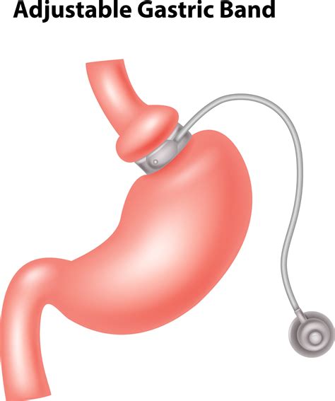 Stomach Gastric Banding Surgery | Deepam MediTours