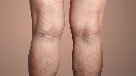 Are Varicose Veins Dangerous? What Are The Symptoms & Treatments? - Laser Vascular Center