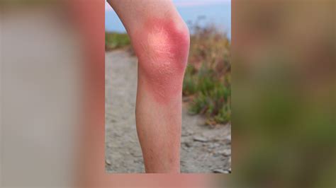 Are Moon Jellyfish Stings Bad