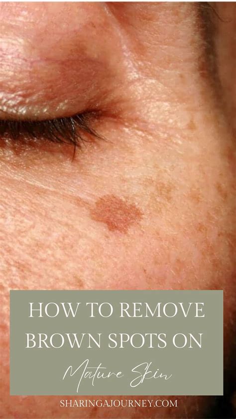 Remove Dark Spots In Just 3 Nights By Doing This Trick | Brown spots on face, Spots on face ...