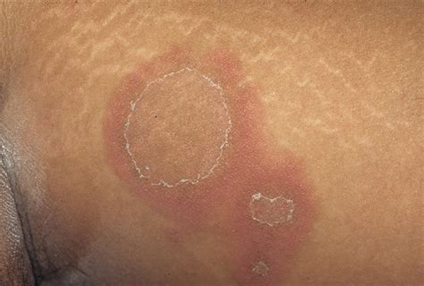 Erythema Annulare Centrifugum Thigh