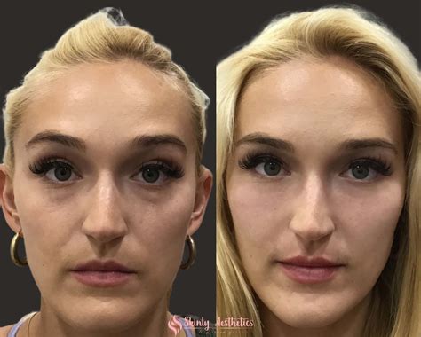 Under Eye Fillers - Before & After Results at Skinly
