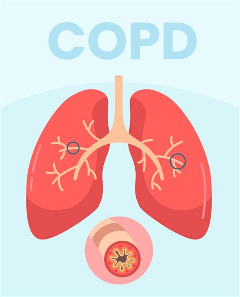 Chronic Obstructive Pulmonary Disease - SynappseHealth