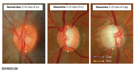 Primary Open-Angle Glaucoma | Clinical Features | Geeky Medics