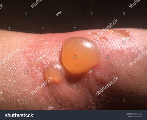 Third Degree Burn Blister