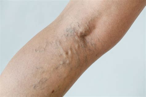 Understanding Bulging Veins in Arms: Causes, Varicose Veins, and Superficial Thrombophlebitis