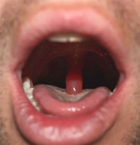 How Long Swollen Uvula After Tonsillectomy (And Why)?