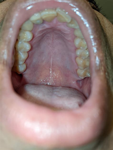 Bumps on mouth roof : r/DentalHygiene