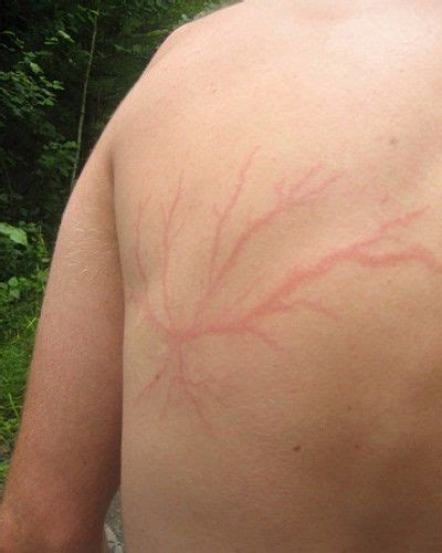 Lightning Scars Back