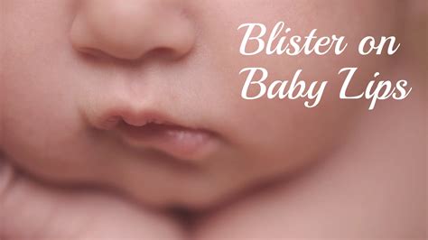 Blister On Baby Lip: Its Causes, Treatments, And More