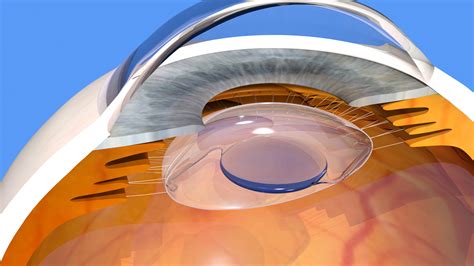 Multifocal Lens (intraocular lenses): pros and cons, prices and success ...