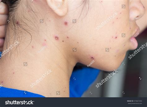 Chicken Pox Scars On Arms