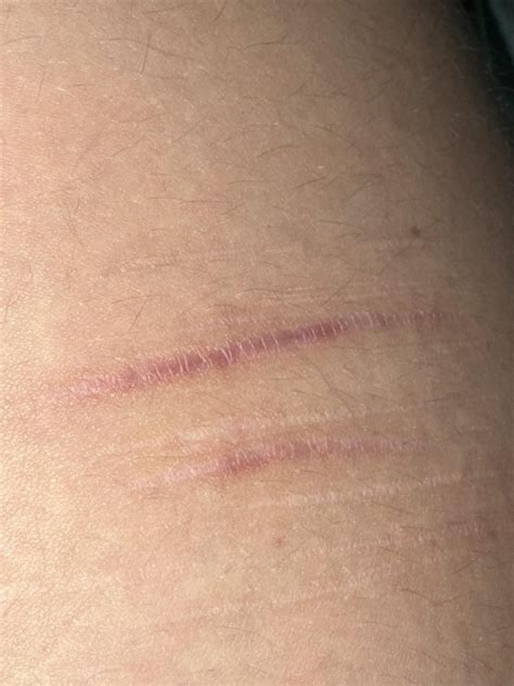 possible hEDS—unsure about diagnostic criteria for skin. is this ...