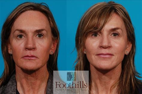 About Faces Cosmetic Surgery Tucson Az