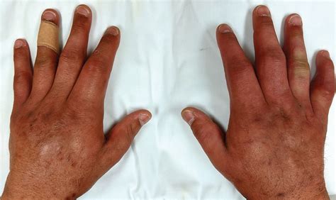 Pregnant Swollen Hands