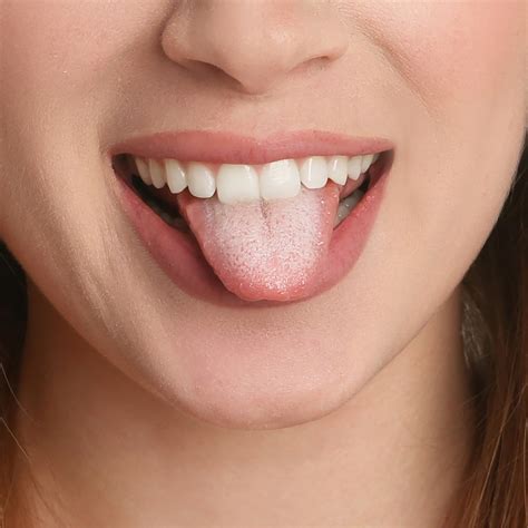 White Tongue Symptoms Are Oral Mucosal Changes A Sign Of COVID 19? A