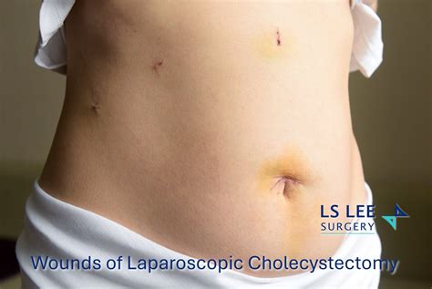 Laparoscopic Cholecystectomy Singapore | Keyhole Gallbladder Surgery