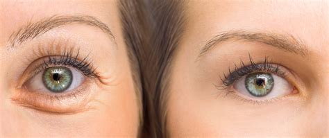 Does Botox Help with Eye Bags? Truth and Alternatives for Puffy Eyes - TheWellnessVerse