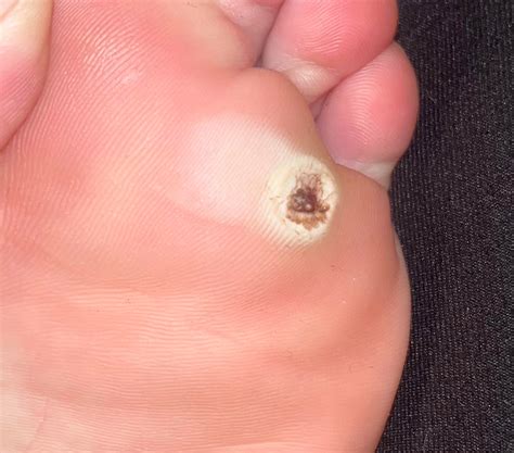 Super painful plantar warts : r/Warts