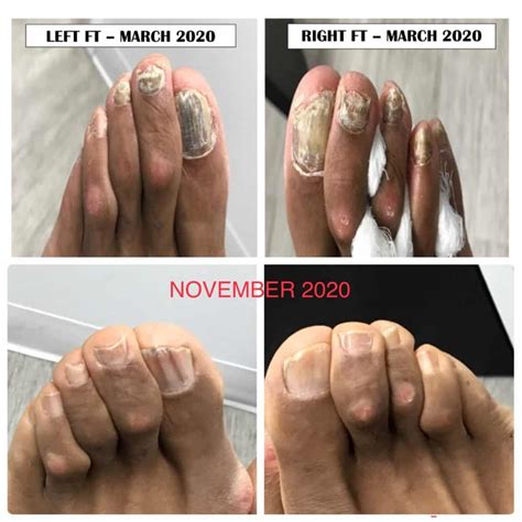 Toenail Fungus - Bregman Foot-Ankle & Nerve Center