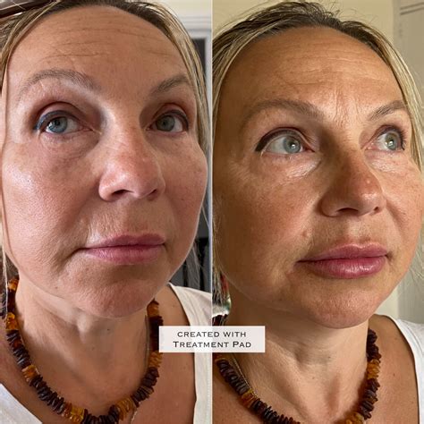 Do Cheek Fillers Lift Marionette Lines at Gary Delariva blog