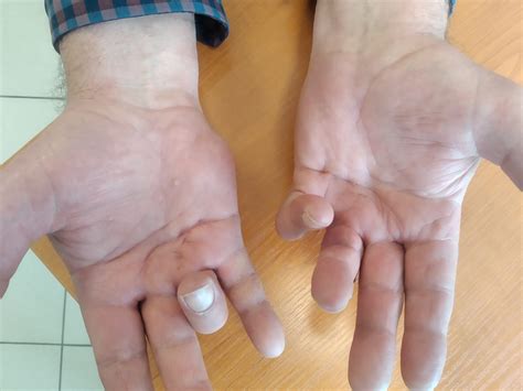 Ortopeda Rzeszów | Przykurcz Dupuytrena