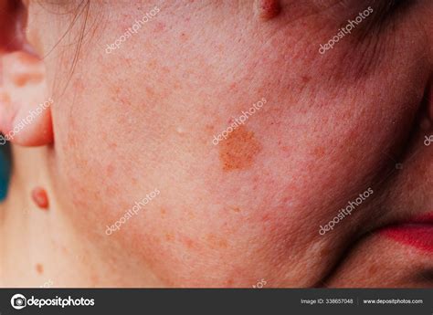 Red Age Spots