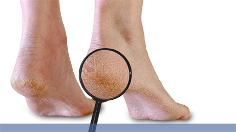 How to Treat and Prevent Heel Cracks - Waikato Podiatry