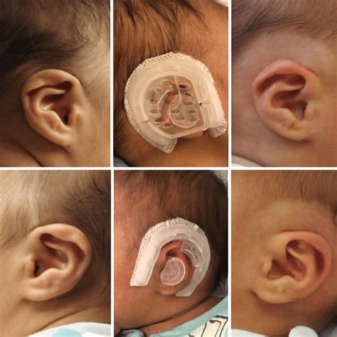 Baby Ear Cartilage Development at Alexis Whitaker blog