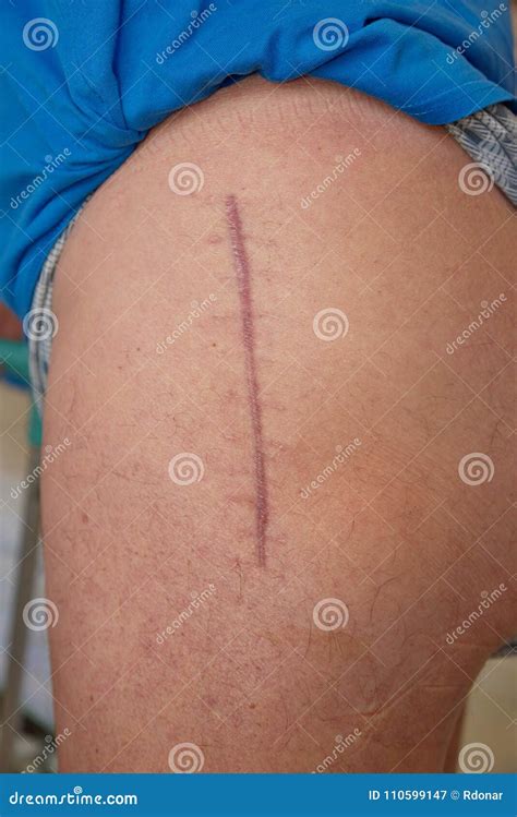 One Year Old Scar after Hip Replacement Surgery Stock Image - Image of ...
