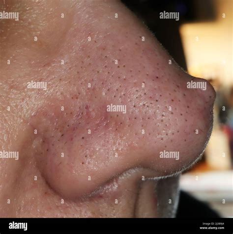 Facial wart hi-res stock photography and images - Alamy
