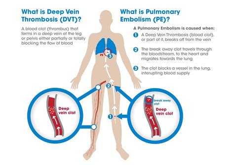 Venous Thromboembolism (DVT/PE)- Facts – The Operating Room Global ...