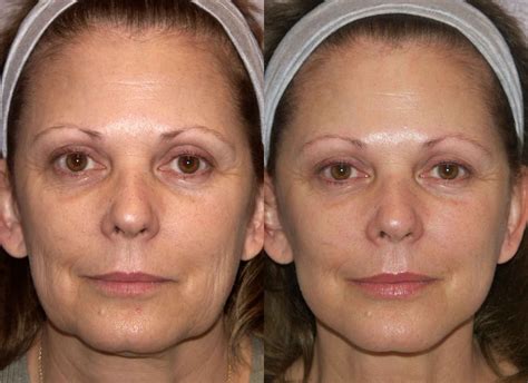 Mini Face Lift, Mini Lift, Face Lift | Mini face lift, Face lift surgery, Forehead lift