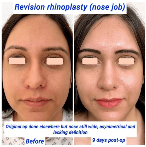 Revision Rhinoplasty: Everything You Need to Know