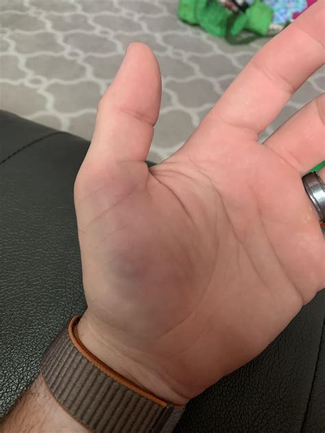 Anyone else get a bruised thumb after golfing? Golfed yesterday and today and never had this ...