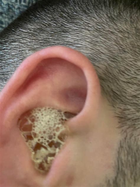 Blocked ear + Peroxide : r/earwax