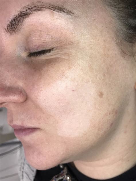 Hypopigmentation On Face Polymorphic Light Eruption: Multiple