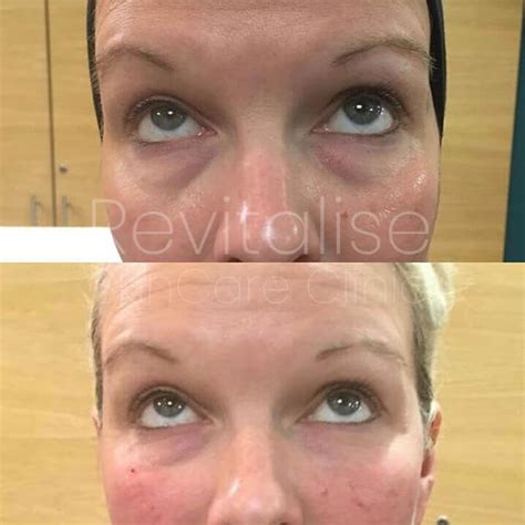 Hollow Under Eye Treatment (Tear Trough) - Revitalise Skincare Clinic ...