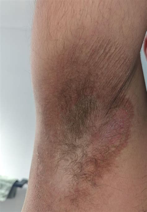 Candida Infection Under Armpit
