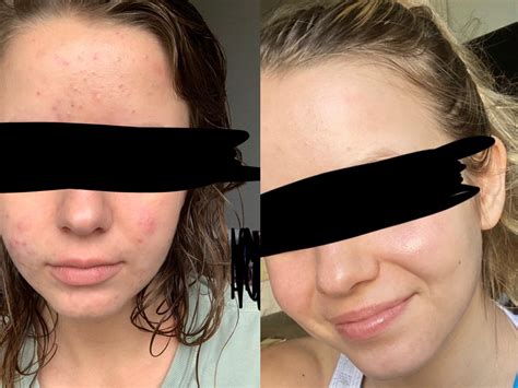 Retin-A micro gel and pregnancy : r/tretinoin