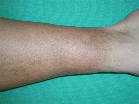 Lower Leg Discoloration