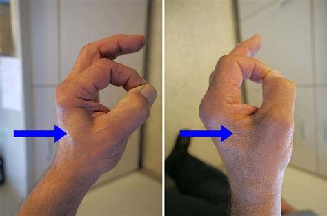 Ulnar Nerve Entrapment at the Elbow (Cubital Tunnel Syndrome ...