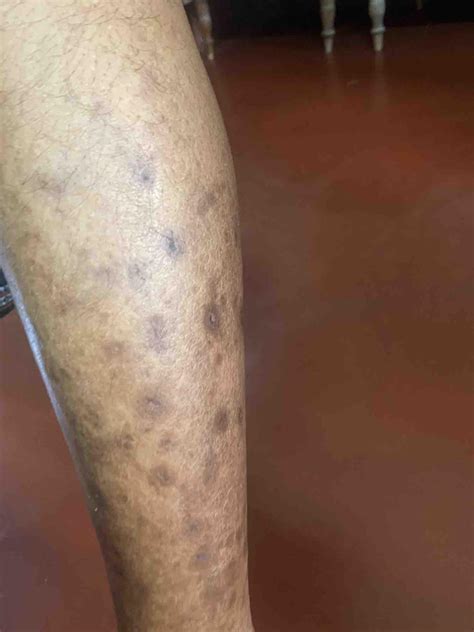 Black Spots On Legs Symptoms at Joyce Mckenzie blog