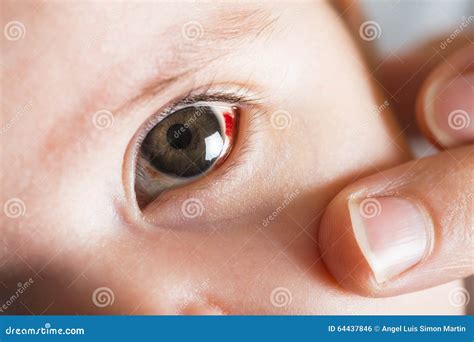 Subconjunctival Hemorrhage Newborn
