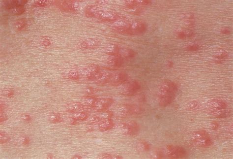 13 Pictures of Common Skin Rashes