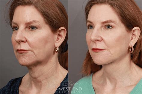 Deep Plane Facelift & Neck Lift, Brow Lift, Eyelid Lift, Lip Lift, Fat Grafting, and CO2 ...