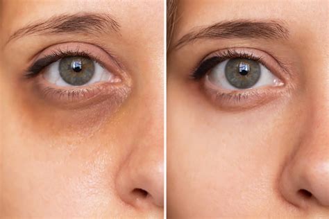 Under-Eye Dark Circle Treatment Calgary - Ensoul Aesthetic & Wellness