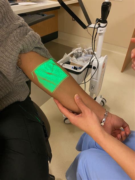 AccuVein "Vein Finder" Illuminates Veins, Aiding IV Insertion